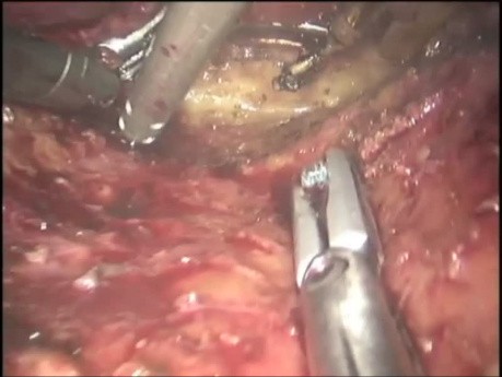 Résection abdominopérinéale robotisée avec sacrectomie distale