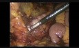 Colectomie totale avec anastomose iléo-rectale par voie laparoscopique