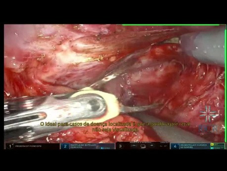 Prostatectomie Radicale Robotique 