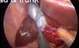 Anatomie de la vésicule biliaire lors d'une opération laparoscopique par incision unique