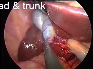 Anatomie de la vésicule biliaire lors d'une opération laparoscopique par incision unique