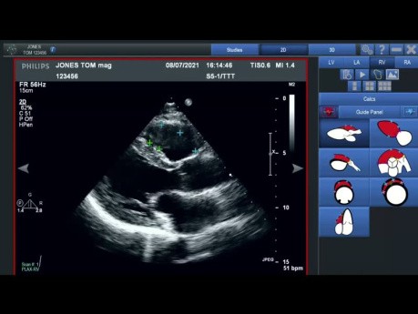 Introduction au VMS+ de Ventripoint pour les Mesures Cardiaques