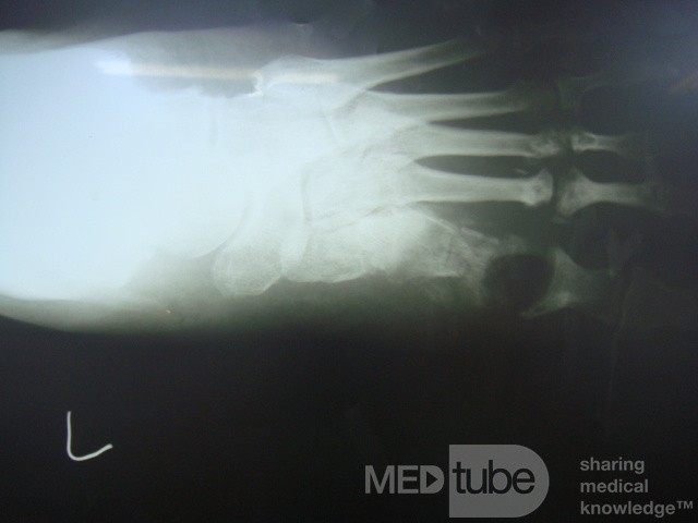 La radiographie du pied avec ostéomyélite.