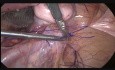 Cervico-sacropexie Laparoscopique avec Filet Proline 
