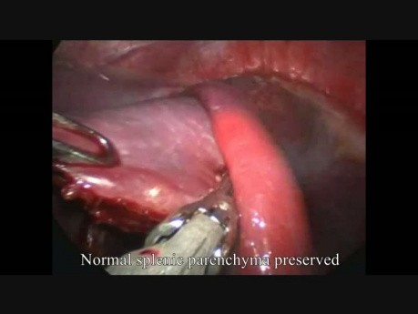 Ablation du kyste splénique par voie laparoscopique