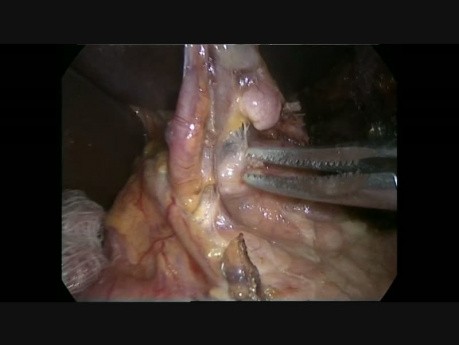 Oesophagectomie Ivor-Lewis par chirurgie à accès minimal
