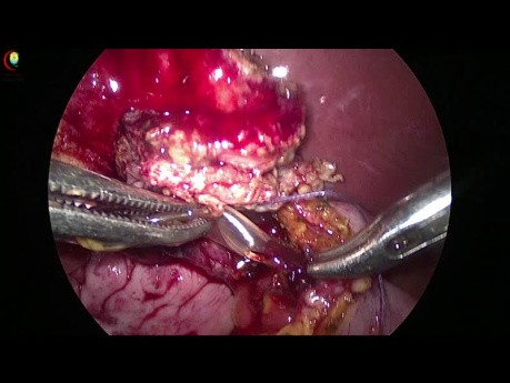 Piégeage du Stent dans les Sutures