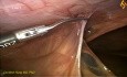 Chirurgie laparoscopique de révision de hépaticojéjunostomie