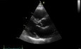 L'échocardiographie 3D en temps réel - vue à long axe parasternal de la valve mitrale (VM) , vidéo n ° 3