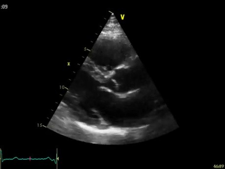 L'échocardiographie 3D en temps réel - vue à long axe parasternal de la valve mitrale (VM) , vidéo n ° 3