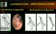 Appendicectomie laparoscopique - Chirurgie opératoire