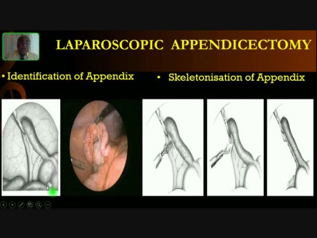 Appendicectomie laparoscopique - Chirurgie opératoire