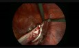 Exérèse laparoscopique d'un gros kyste ovarien