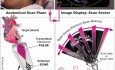 Qu'est ce qu'on voit à Echocardiogramme?