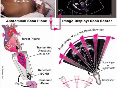 Qu'est ce qu'on voit à Echocardiogramme?