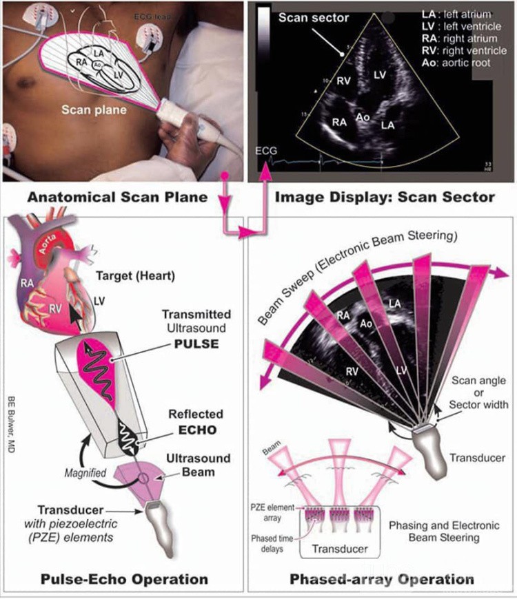 Qu'est ce qu'on voit à Echocardiogramme?