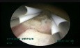 Résection d'un fibrome sous-muqueux de 4,5 cm à l'aide d'un résectoscope bipolaire