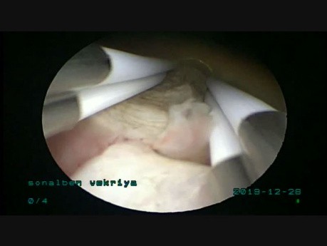 Résection d'un fibrome sous-muqueux de 4,5 cm à l'aide d'un résectoscope bipolaire