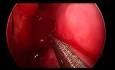 Rhinosinusite Chronique avec Polypes - Chirurgie Fonctionnelle Endoscopique des Sinus