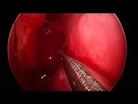 Rhinosinusite Chronique avec Polypes - Chirurgie Fonctionnelle Endoscopique des Sinus
