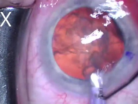 Cataracte avec Dilatation Omni et Implant Hydrus