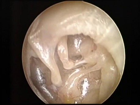 Otite Moyenne Adhésive - Examen Endoscopique