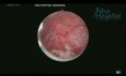 Myomectomie hystéroscopique des fibromes FIGO type 1 et 2
