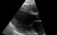 Échocardiographie parasternale grande axe chez un patient atteint de cardiomyopathie dilatée