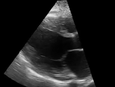 Échocardiographie parasternale grande axe chez un patient atteint de cardiomyopathie dilatée