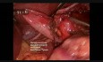 Fundoplicature de Nissen Laparoscopique