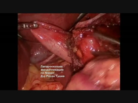 Fundoplicature de Nissen Laparoscopique