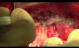 Chirurgie cytoréductive du cancer de l'ovaire. Le décapage du diaphragme.