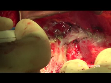 Chirurgie cytoréductive du cancer de l'ovaire. Le décapage du diaphragme.