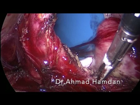 Hystérectomie laparoscopique totale avec Ligasure