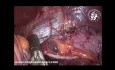 Reprise de Gastrectomie Sleeve en Mini-Bypass Gastrique