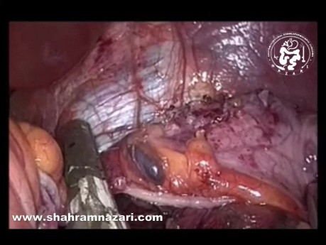 Reprise de Gastrectomie Sleeve en Mini-Bypass Gastrique