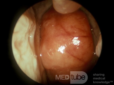 Carcinome du nasopharynx