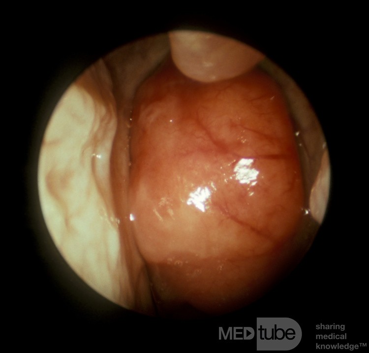 Carcinome du nasopharynx