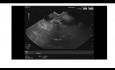 Lésion ampullaire à un stade précoce, écho-endoscopie