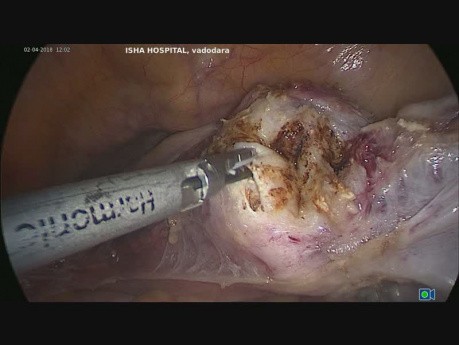 TLH et suspension de la voûte vaginale par pectopexie (partie 1)