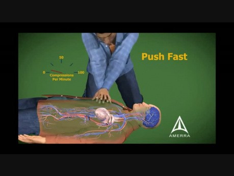 La réanimation cardiopulmonaire (RCP) -Animation médicale 3D