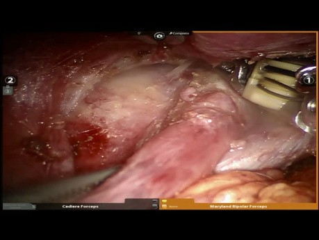Tératome médiastinal - chirurgie robot-assistée