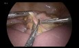 Laparoscopie en cas d'Occlusion du Grêle
