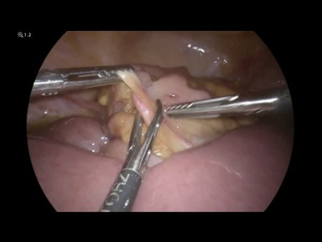 Laparoscopie en cas d'Occlusion du Grêle