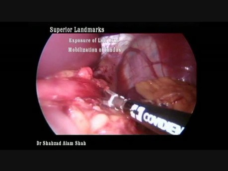 Gastrectomie Sleeve - Ma Technique