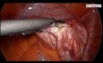 Kystectomie ovarienne par laparoscopie - Aspiration par l'aiguille transparente