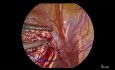 Myomectomie Laparoscopique ( Avec Commentaire Vocal )