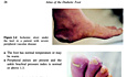 L'atlas du pied diabétique