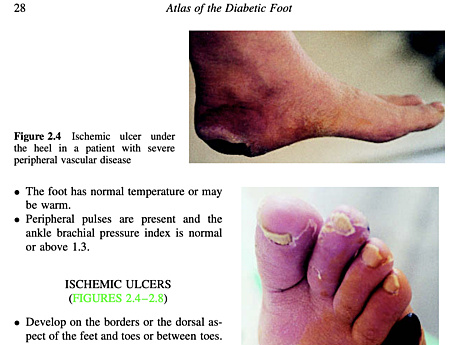 L'atlas du pied diabétique