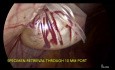 Sac d'Extraction pour Cystectomie Dermoïde 